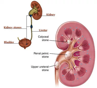 Treatment of kidney stones, ureteral stones by Percutaneous Nephrolithotomy technique